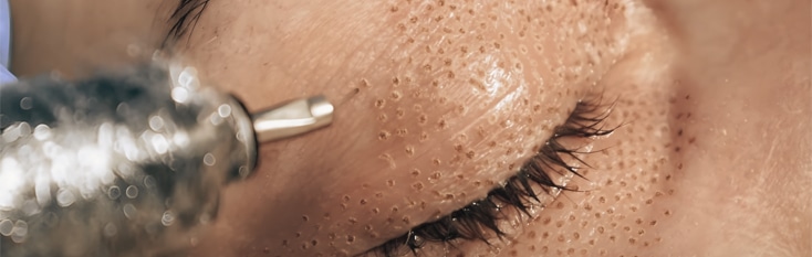 Close-up of a metal skin tool working on a pore-filled eyelid area during a facial.